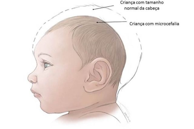bebe-com-microcefalia-tamanho-da-cabeca